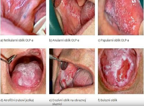 Atrofičan oblik najčešće na dorzumu jezika i gingivi, sa atrofijom i upalom uz crvenilo, simptomatičan oblik (16,26,27). Slika 10* Forme oralnog lihen planusa (36) Preuzeto iz Alajbeg I. i saradnici.