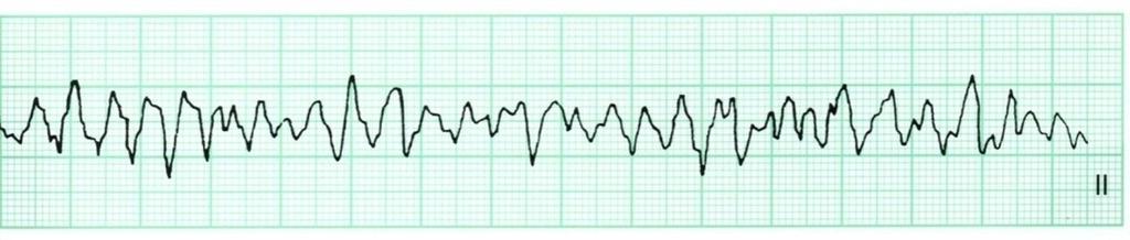 kardiopulmonalna reanimacija. (Bergovec 2011) Karakterističan izgled VF obično se lako prepoznaje.