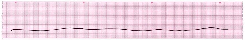 provjeriti jesu li EKG elektrode spojene na prsni koš i je li na monitoru izabran ispravan električni odvod. Provjeriti amplitudu.