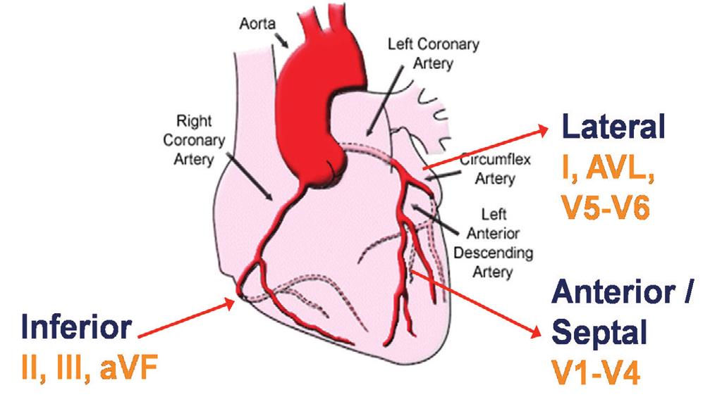 попуштања срца, захваћеност миокарда некрозом је 25% Слика 3 десни и постериорни ЕКГ одводи Знаци тампонаде миокарда (руптура срца) Клинички слика може бити блага или чак могу да изостану