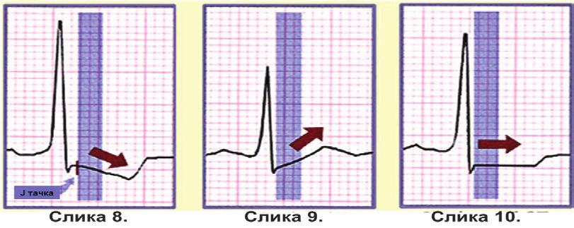Слика 8 а, б и ц кардијални тропонин тропонин Т и тропонин И), говори се о инфаркту миокарда без СТ-сегмент елевације (НСТЕМИ).