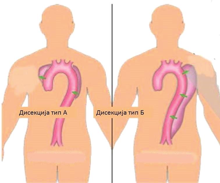 асцедентне аорте у лук и/или нисходну аорту) и тип Б (која захвата само нисходну аорту).