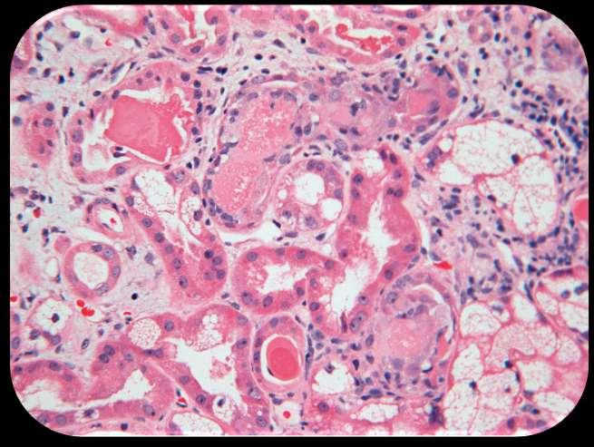 Biopsija bubrega Myeloma cast nephropathy, Myeloma kidney.