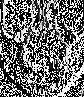 Izvaalong the nasal floor posteriorally up to the posterior edge of the maxilla. The roots of the erupted frontal teeth were partially resorbed and the teeth were mobile (Figs. 3,4,5).