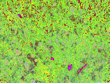 Horizontal CT cross-section showing the amount of bony tissue destroyed by the granuloma.