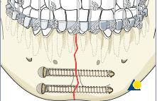 Slika 21. Fiksacija uz pomoć kompresijskih vijaka. Preuzeto: (23 14.2. Liječenje prijeloma korpusa Terapija izolovanih fraktura tijela mandibule kod pacijenata koji imaju zube je konzervativna uz primjenu imobilizacije u trajanju od 6 sedmica.