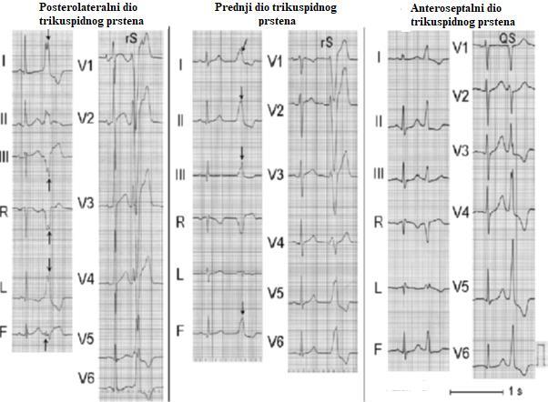 ARITMIJE ISHODIŠTA IZ TRIKUSPIDNOG PRSTENA Slika 3.2. EKG prikaz aritmija podrijetla iz tri različita dijela RTP. Strelice označavaju pojavu zareza QRS kompleksa.