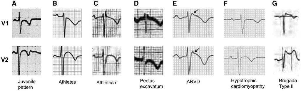 ARITMIJE ISHODIŠTA IZ IZGONSKOG TRAKTA DESNE KLIJETKE Slika 5.8. Usporedba EKG nalaza nekih od diferencijalnih dijagnoza ARVC-a u V1 i V2 odvodima.