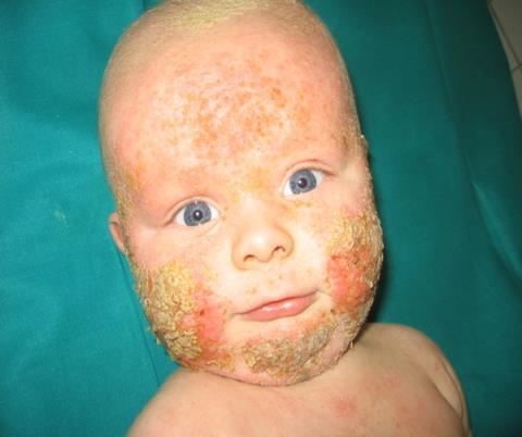 ctnaturopathic.com/eczema/ Na ovako izmjenjenoj koži česta je bakterijska superinfekcija (sl.6).