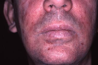 Atopijski dermatitis s početkom u odrasloj dobi je ona forma oboljenja koja se po prvi put javlja kod pojedinca u odrasloj dobi, de novo, Bannister i Freeman (36).