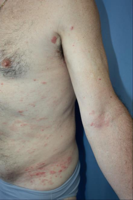 4.3.8. Psorijaziformni dermatitis Neki pacijenti imaju difuzne psorijaziformne kutane lezije na području trupa, udova i pregiba.