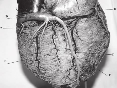 Slika 3. Desni tip arterijske vaskularizacije srca: A- r. circumflexus; B- a. coronaria dextra; C- r. interventricularis posterior a.
