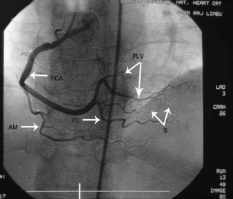 Slika 6. Angiografski prikaz a. coronariae dextrae kod desnog tipa arterijske vaskularizacije srca RCA- a.