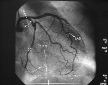 Slika 7. Angiografski prikaz a. coronariae sinistrae kod lijevog tipa arterijske vaskularizacije srca: LM- glavno stablo a.