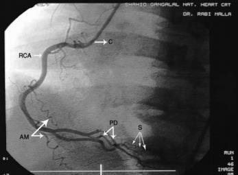Slika 8. Angiografski prikaz a. coronariae dextrae kod simetričnog tipa arterijske vaskularizacije srca: RCA- a. coronaria dextra; C-kateter; AM- r. marginalis dexter; PD- r.