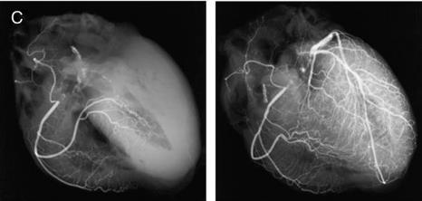 Slika 11. Postmortem koronarna angiografija.