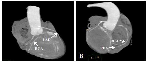 Slika 12. CT koronarni angiogram desnog tipa arterijske vaskularizacije srca. A) r.