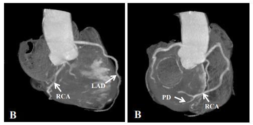 Slika 14. CT koronarni angiogram desnog tipa arterijske vaskularizacije srca. A) r.