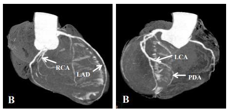 Slika 16. CT koronarni angiogram lijevog tipa arterijske vaskularizacije srca. A) r. interventricularis anterior (LAD) doseže vrh srca, te zavija oko istog; B) r.