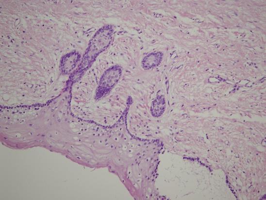 Rezultati Napomena: hiperplazija 1- hiperplazija u uzocima uzetim pre dekompresije, hiperplazija 2- hiperplazija u uzorcima uzetim nakon dekompresije Epitelni produžeci su viđeni u tri uzorka pre i u