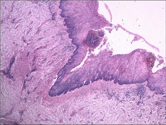 Rezultati a) b) c) Slika V-8 Prisustvo inflamacije sa znacima a) nekroze i b) koilocitoze u KCOT; c)