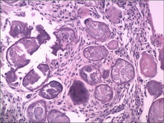 2.3. Imunohistohemijska analiza Ekspresija survivina, ciklina D1 i p21hras u KCOT i