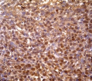 TUNEL % TUNEL + ћелија у ткиву карцинома дојке A) 60 40 20 0 Б) Нетретирани CDDP DE-EDCP Графикон 8.