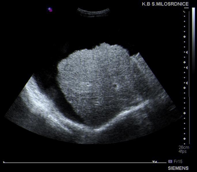 Slika 5: Ciroza jetre: skvrčena jetra, četkasti izgled čahure. Prema Duvnjak M. i suradnici (2015). (54) 5.