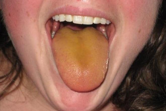 Simptomi koji se mogu javiti uz žut jezik su: loš zadah, bol u grlu, bijele mrlje na jeziku, papile mogu biti otečene, suhoća usta, povišena tjelesna temperatura, bol i otečenost jezika, probavne