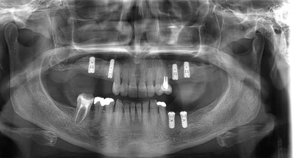 Resonance frequency analysis as a reliable criterion for early loading of sandblasted/acidetched active surface