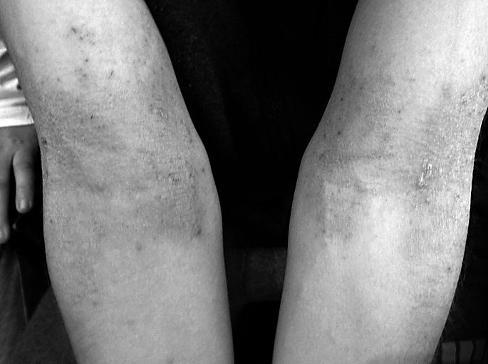 Slika 2. Dermatitis pregiba henifikacije (Slika 3).