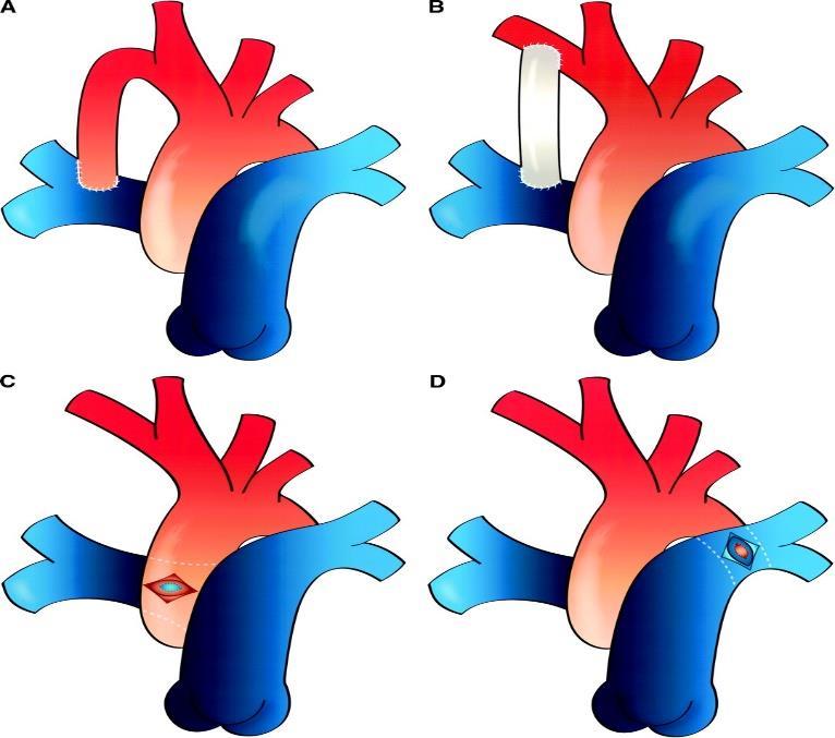 (od pulmonalnog trunkusa), isključenje pluća iz cirkulacije (presijecanjem plućne arterije) i opskrbom pluća putem aortopulmonalne anastomoze (Norwood operacija sa B-T shuntom) (Slika 1 i 2) ili
