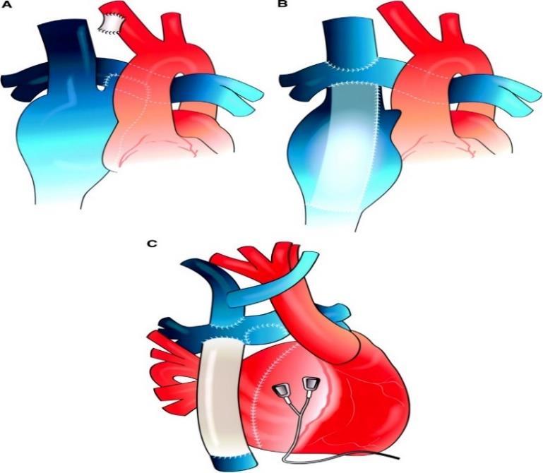 krv se iz gornje šuplje vene odvodi u pluća, a iz donje šuplje vene preko intraatrijskog provodnika, lateralnog tunela ili ekstrakardijalnog provodnika (Slika 4).