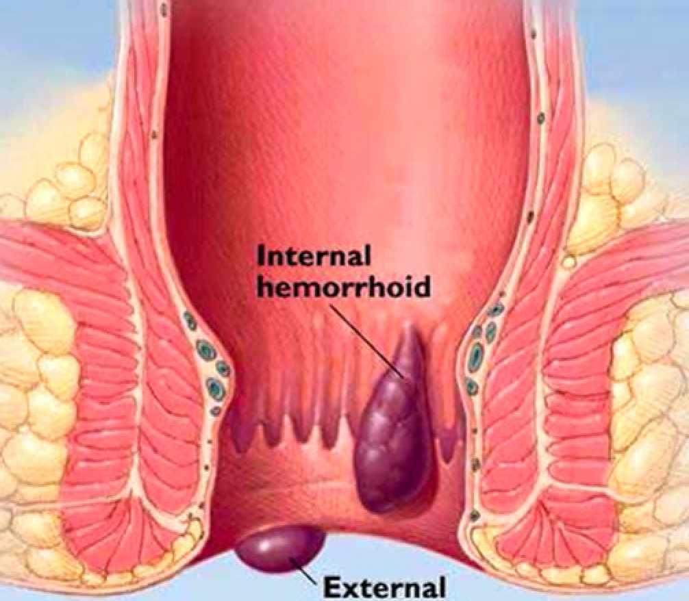 Zbog toga se unutrašnji hemoroidi nalaze na tipičnim mjestima - na tri, sedam i jedanaest "sati, ako se pacijent nalazi u položaju na leđima i ako se označavaju brojkama na