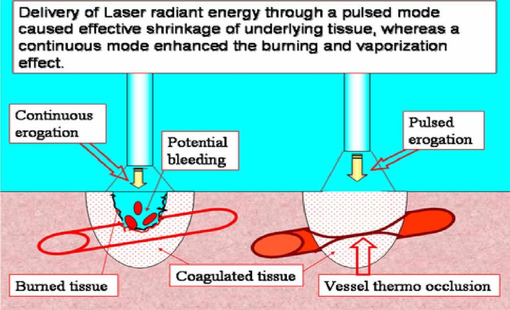 Studija spektra apsorpcije vode i krvi između 800 i 1500 nm dala nam je potrebne informacije za izbor optimalne laserske talasne dužine potrebne za HeLP tehniku (slika16).