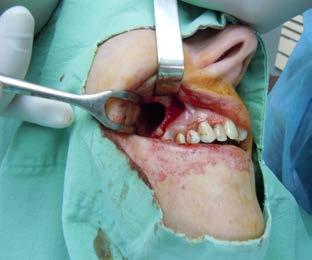 Neposredno nakon operacije gaza natopljena jodoformom u rezidualnom koštanom defektu Figure4 Immediate postoperative view of iodoform gauze tape inside the remaining cystic bone defect Slika 5.