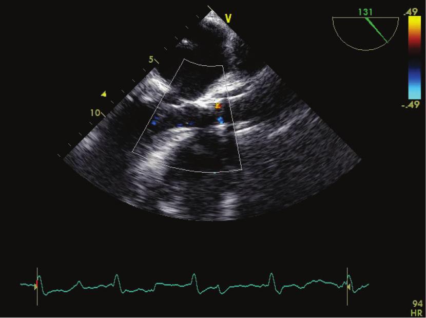 29 A B C A. Good position of the valve, long-axis view B. Good hemodynamic result, deep transgastric view C. Mild paravalvular leak, short axis view Figure 2.