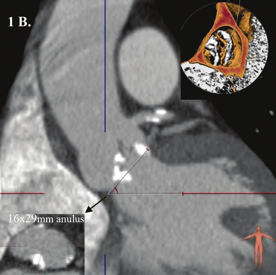 Na multislajsnoj kompjuterizovanoj tomografiji (MSCT) je izmerena veličina aortnog anulusa 16x29 mm (Figura 1b), kao i ostale dimenzije aorte: bulbus aorte 30 mm, sinotubularni spoj aorte