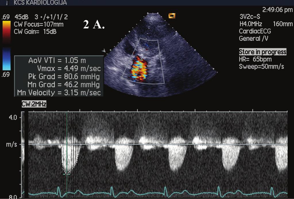 32 2a. Gradijent nad aortnom valvulom pre intervencije 2b. Veličina aortnog anulusa 2c. Pozicija aortne valvule i paravalvularna aortna regurgitacija na aortografiji 2d.