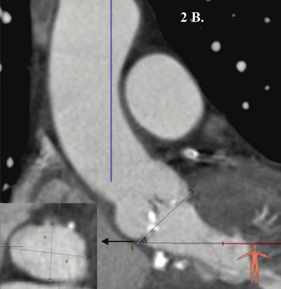 Nakon zamene meke za tvrdu žicu, urađena je predilatacija aortne valvule balonom Nucleus 22x40 mm (NuMed Canada Inc.) (Figura 1c) tokom brzog pejsinga (Fr180/min.