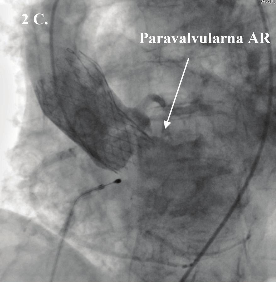 Nakon toga je uz pomoć aortografije i pig-tail katetera, koji se pozicionira u nekoronarni sinus, i služi i kao marker za pozicioniranje valvule i za opacifikaciju korena aorte, pozicionirana (Figura