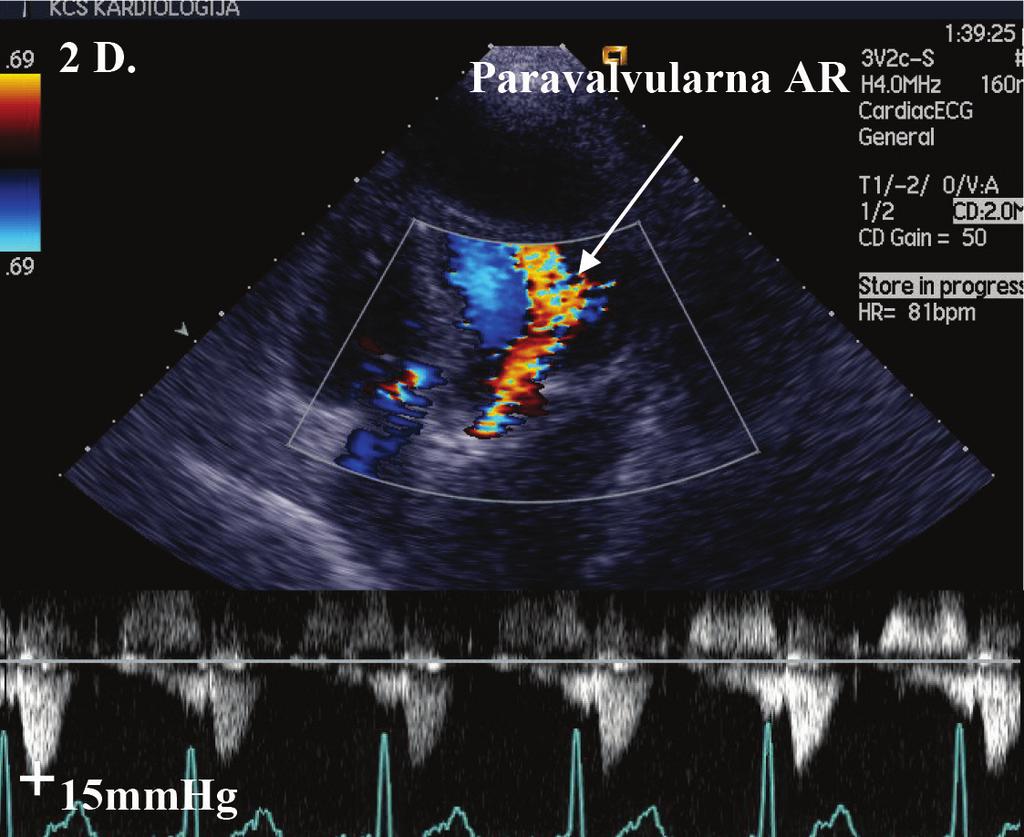 Na kontrolnoj aortografiji je viđena paravalvularna aortna regurgitacija 1+ sa uredno pozicioniranom valvulom na aortnoj poziciji (Figura 1e) i gradijentom do 20 mmhg.