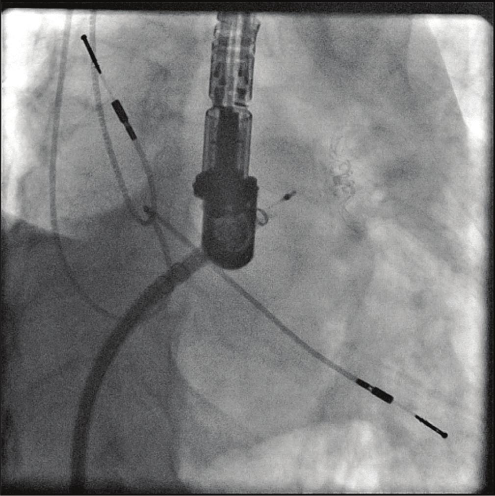 The LAA morphology is then carefully analysed in both angiograms and transoesophageal echocardio- graphy to determine which size of the Watchman device should be implanted.