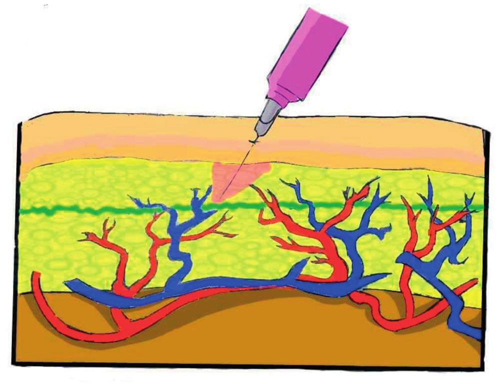 Duboka subkutana injekcija Igla se vertikalno uvodi u subkutano tkivo, na po 2 cm razdaljine, i ubrizgava se oko 10 ml anestetika (Slika 5) 18.