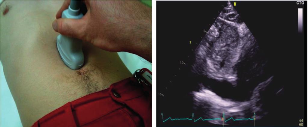 Ritmičnim zatvaranjem i otvaranjem aortne i mitralne valvule, kao 191 na mesto udara srčanog vrha. Kursor sonde je usmeren ka levom ramenu, kao i marker koji se nalazi u levom gornjem uglu ekrana.