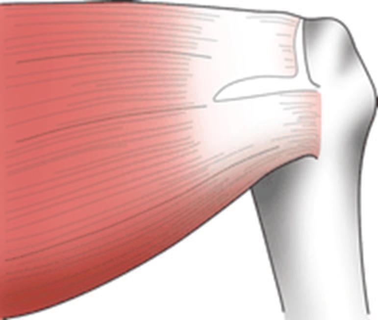 Razlikujemo parcijalne i potpune rupture rotatorne manžete ramena. Parcijalnom lezijom smatra se ona tetiva koja je istrošena i stanjena na mjestu dodira s akromionom te u području kritične zone (1).