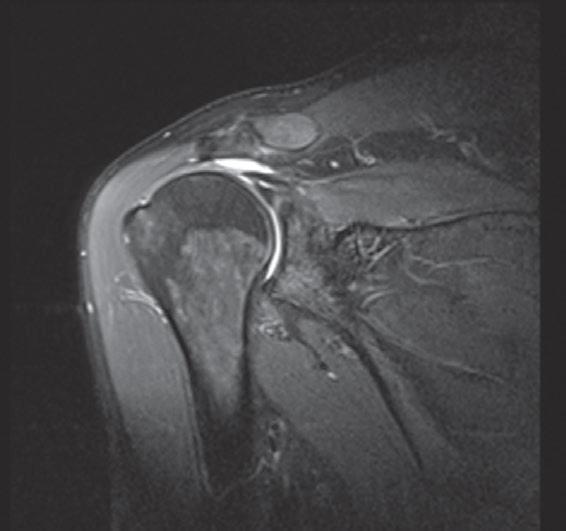 Slika 8. MR prikaz rupture supraspinatusa. Bijelo područje ukazuje na retrahiranu tetivu s izljevom i kranijalnu migraciju glave humerusa (strelica). Prema: (1). 9.4.