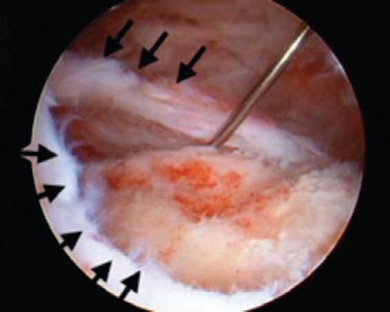 Slika 9. Fotografija artroskopskog prikaza rupture tetive mišića supraspinatusa. Strelice pokazuju rub defekta. Prema: (1). 10.