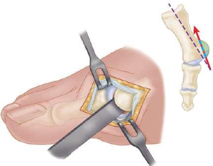 kirurško liječenje metatarsofalangealnog zgloba