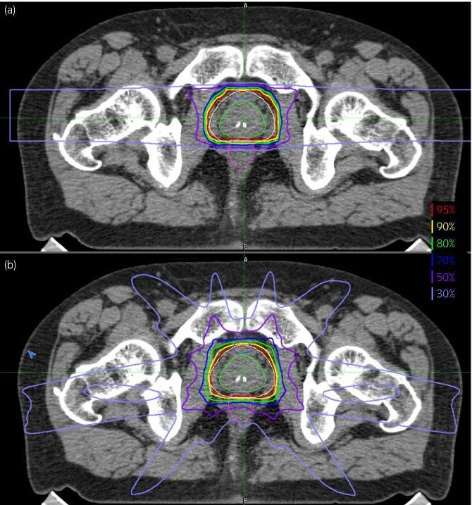 Slika 6. Prikaz distribucije doze na transverzalnim presjecima pri radioterapiji karcinoma prostate *6a. Distribucija doze kod terapije ugljikovim ionima *6b.